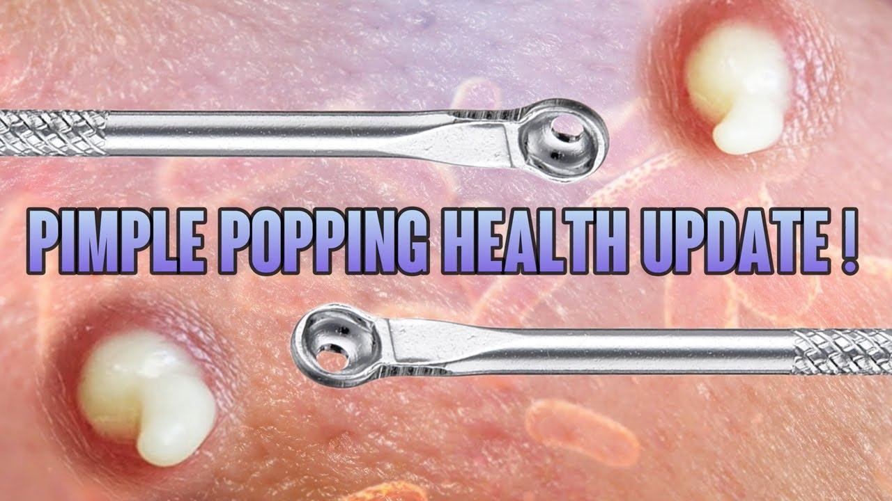 Blackheads vs Whiteheads! Pimple Popping Health Update YouTube
