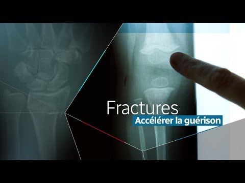 Vidéo: Comment réaligner un os fracturé : 8 étapes (avec photos)