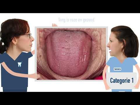 Video: Hole In Tongue: Kan Het Tongkanker Zijn? Plus, Andere Oorzaken