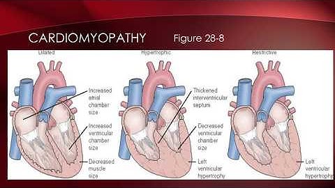Perfusion, Part 2: Cardiomyopathy, Aneurysm, and DIC