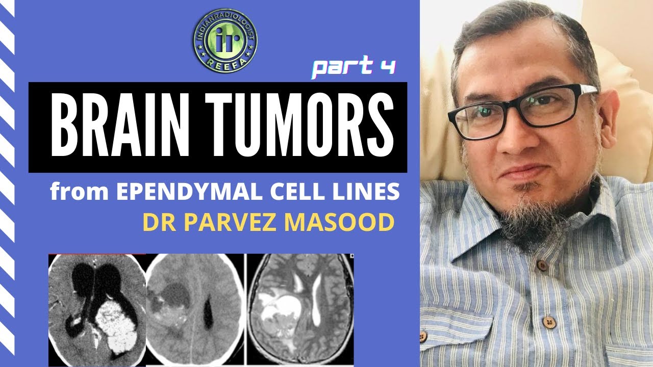 PARVEZ MASOOD | BRAIN TUMORS PART IV | INTRA VENTRICULAR TUMOUR | EPENDYMOMA