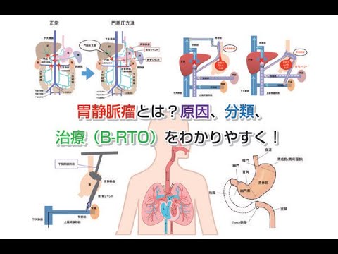 胃食道静脈瘤の原因は？治療法（硬化療法）は？