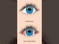 Conjunctivitis Pink Eye 👁️#eyes #eyecareprofessional #eyespecialist #optometrist #conjuctivitis
