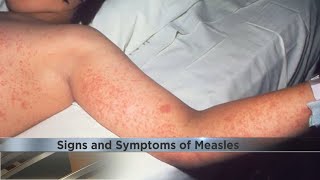 Signs and symptoms of measles