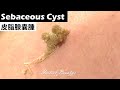 背部皮脂腺囊腫( sebaceous cyst on back ) - Taiwan Tainan台南清粉刺最乾淨