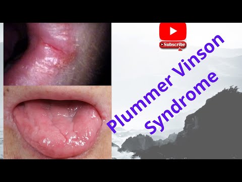 Hội chứng Plummer Vinson-Đánh giá năng suất cao. Xem ngay bây giờ-usmle, neet pg, plab,...