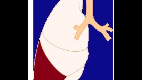 CAP (Community Acquired Pneumonia) Mx & non-resolving Pneumonia_Dr Pradeep Rangappa