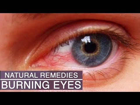 Eye Strain & Burning Eyes Home Remedies - 5 Natural Remedies for Eye Strain, Tired and Burning Eyes- - 동영상