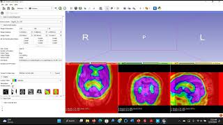 Multimodal Image Registration Using 3DSlicer