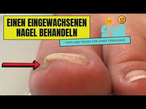 Video: Wie Man Einen Eingewachsenen Zehennagel Schneidet