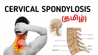 Cervical Spondylosis | Causes | Signs and Symptoms | Risk factor | Treatment | தமிழ். screenshot 5