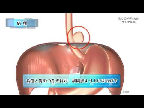 食道裂孔ヘルニア／2分で分かる医療動画辞典　ミルメディカル