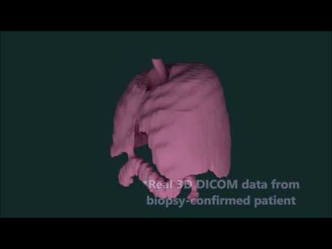 Video: Systembiologisk Analys Avslöjar Ny Insikt Om Invasiv Lungcancer