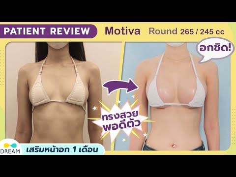 [Dream]รีวิวเสริมหน้าอกครบ 1 เดือน จากห้องตรวจคุณหมอทรงยศ | Motiva 265 cc  ทรงกลม