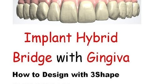 Implant hybrid bridge how you can Scan part 1