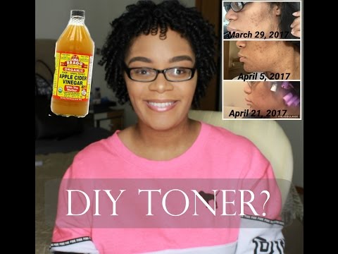 DIY Apple Cider Vinegar Toner for Acne & Oily Skin| Before & After Pictures