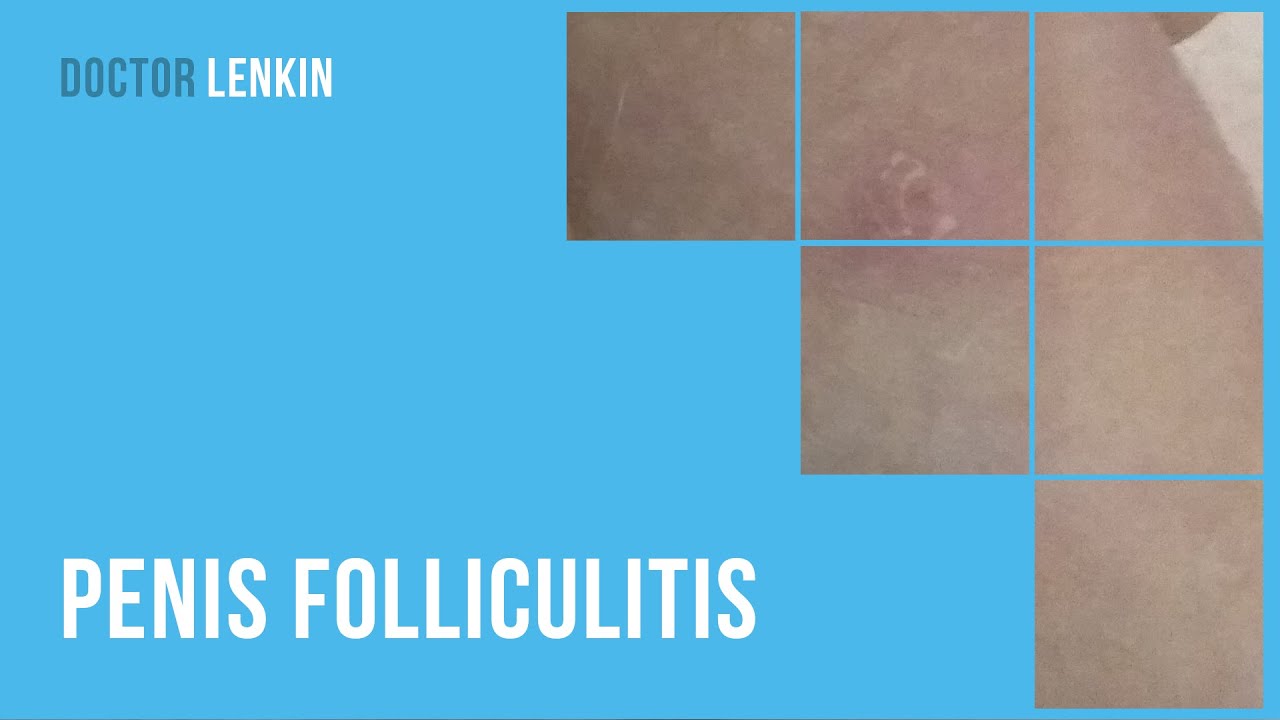 🙄 Penis folliculitis YouTube