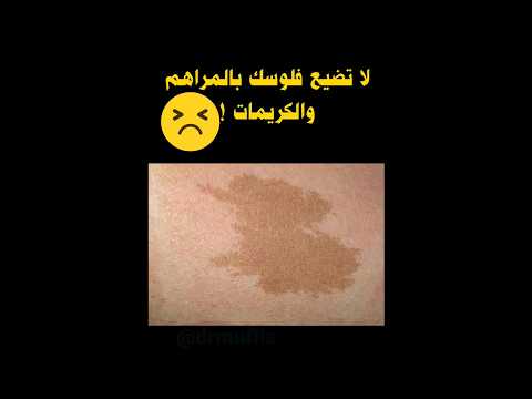 اسباب ظهور البقع الداكنة في الجسم    طبيب مفلس 