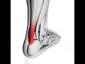 What is Achilles Tendonitis?