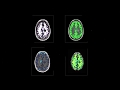 Biomarker segmentation with SyMRI