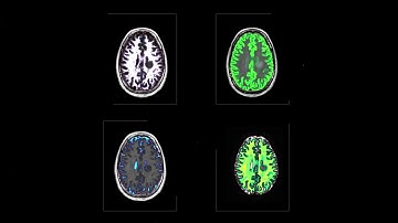 Biomarker segmentation with SyMRI