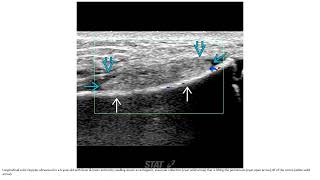 Osteomyelitis Imaging