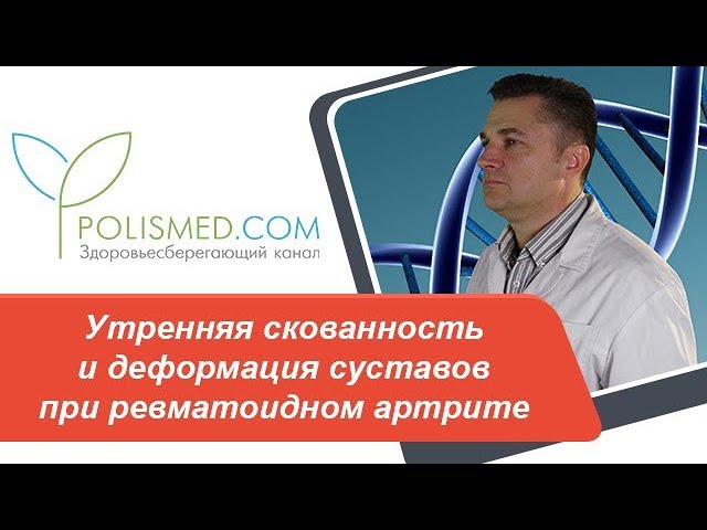 Утренняя скованность и деформация (изменения) суставов при ревматоидном артрите