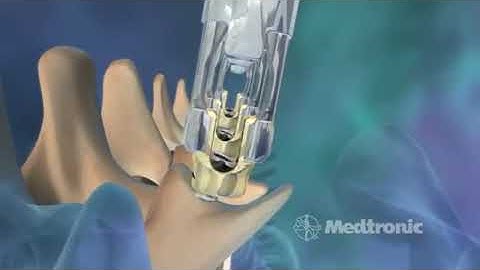Medtronic: CD Horizon Longitude
