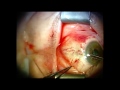 Biotissue cch with suture