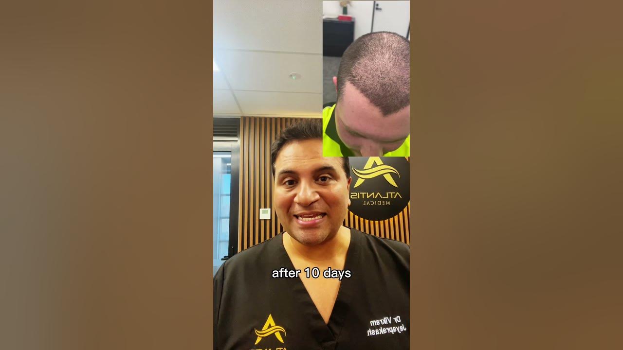 how-long-to-recover-after-a-hair-transplant-youtube