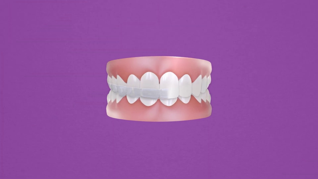 Impact® Night Guards - Best Protection Against Teeth Grinding