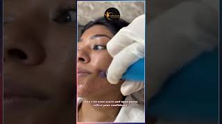 Open Pores & Acne Scars Treatment | Smooth & Clear Skin Solution | Asthederm Mohali #skincare