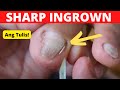 Ingrown toenails treatmentalmas manicure and pedicure vlogsjoyful initial result