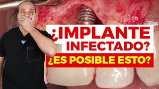 INFECCIONES asociadas a IMPLANTES DENTALES