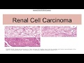 Renal cell carcinoma: Types,Genetics,Morphology