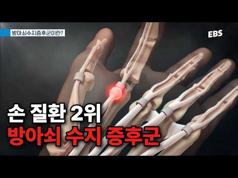 ‘<strong>방아쇠</strong> 수지’일 수 있습니다 | #명의
