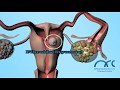 Hysterosalpingogram Procedure | Hysterosalpingogram Video - ARC Chennai