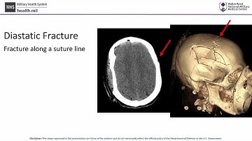 CNS Neurosurgery 100: Skull Fractures