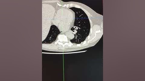 CT interpretation - assessing aortic valve calcification on a non gated CT