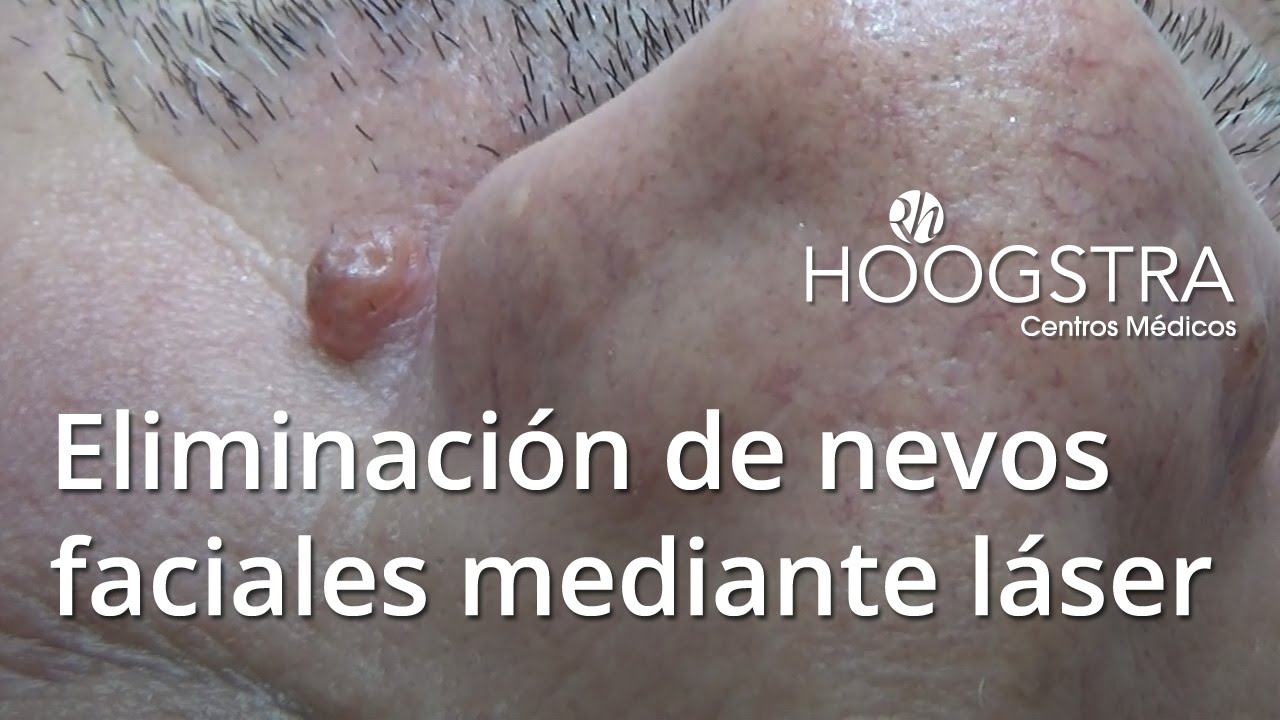 lunarly Eliminación de nevos faciales mediante láser (15029)