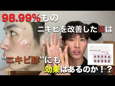 【98.9%が改善】最強のニキビ治療薬”イソトレチノイン（アキュテイン）”はニキビ跡に効果はあるのか？【医学的根拠有り】