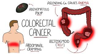 Understanding Colorectal Cancer (Includes Polyps)