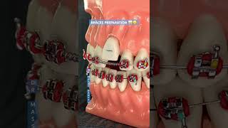 BRACES PREPARATION 🦷😬