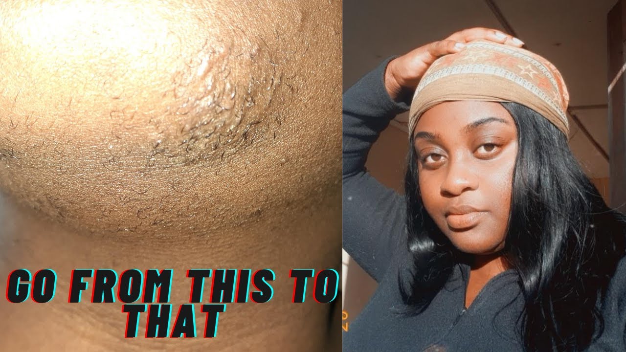REMOVE INGROWNS HAIR ON CHIN WITH ME episode 3 - YouTube