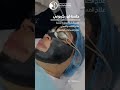 جلسة ليزر كربوني جلسة ليزر كربوني