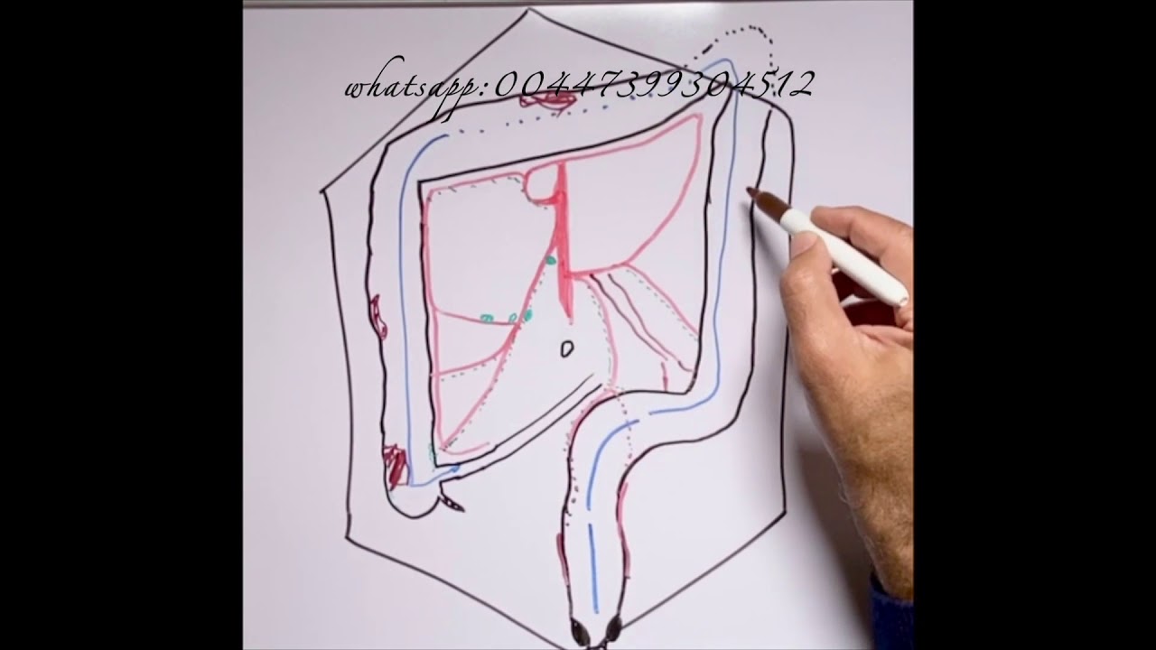 Resection of rectum for cancer  أستئصال المستقيم