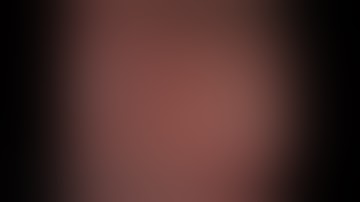 Direct Per-Oral Cholangioscopy for Choledocholithiasis