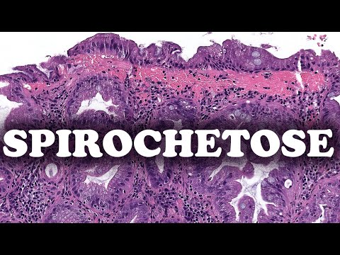 Vidéo: Que signifie spirochétose ?