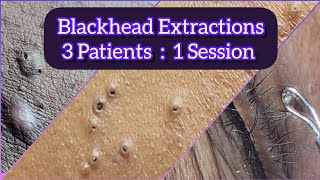 Blackhead extractions in 3 Patients in a single day | @Dr.AMAZINGSKIN