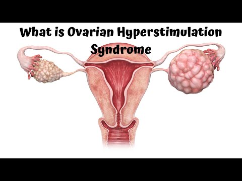 What is Ovarian Hyper-stimulation Syndrome and how is it treated